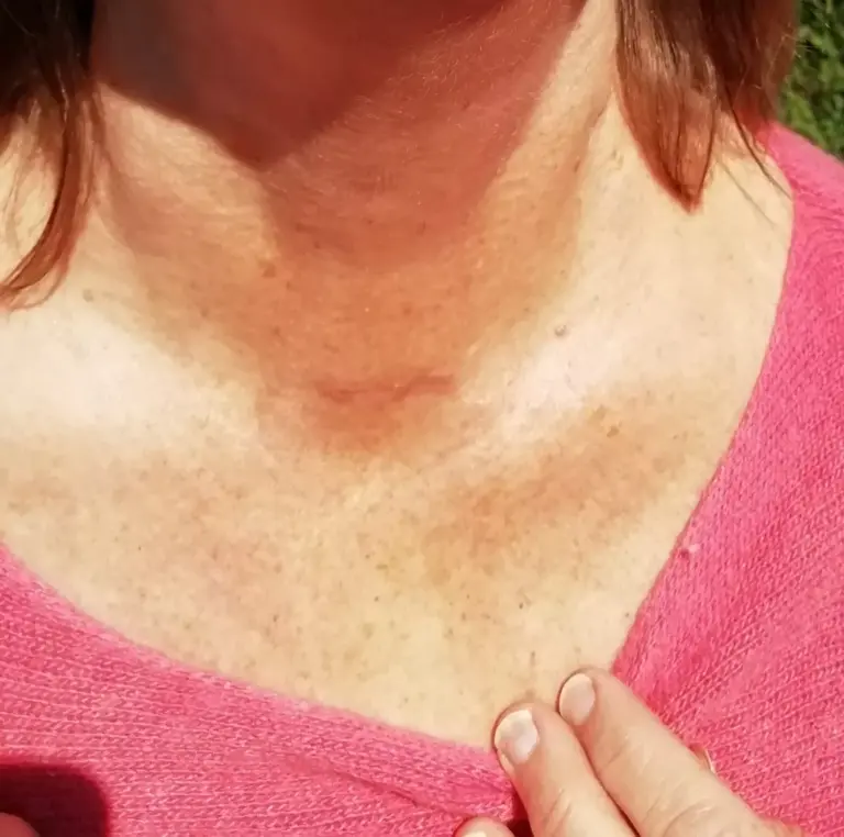 The same patient's neck 6 weeks after parathyroid surgery, with one small scar in the middle of the neck