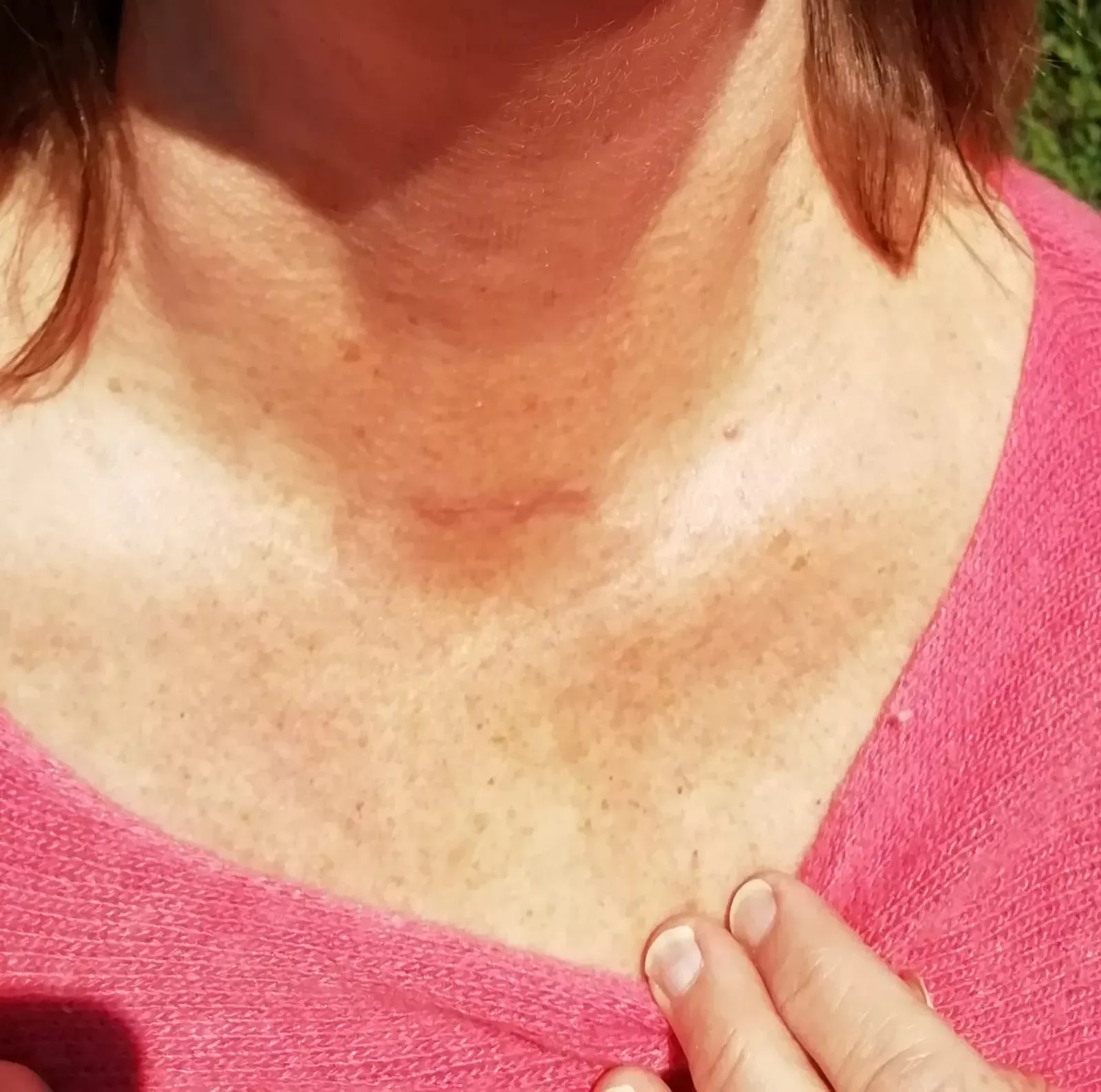 A woman's neck showing a faint, well-healed scar after thyroid surgery