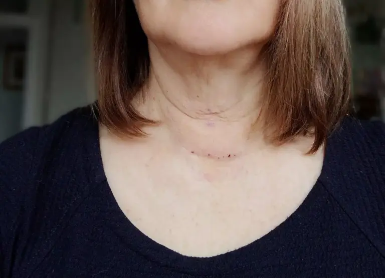 A patient's neck 10 days after parathyroid surgery, with one healing scar in the middle of the neck