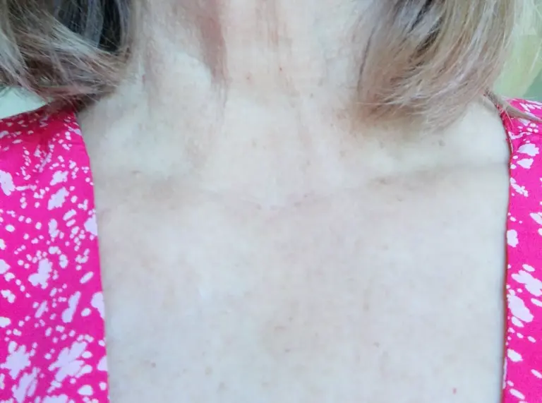 The same patient's neck three and a half months after parathyroid surgery, with a slight trace of the scar
