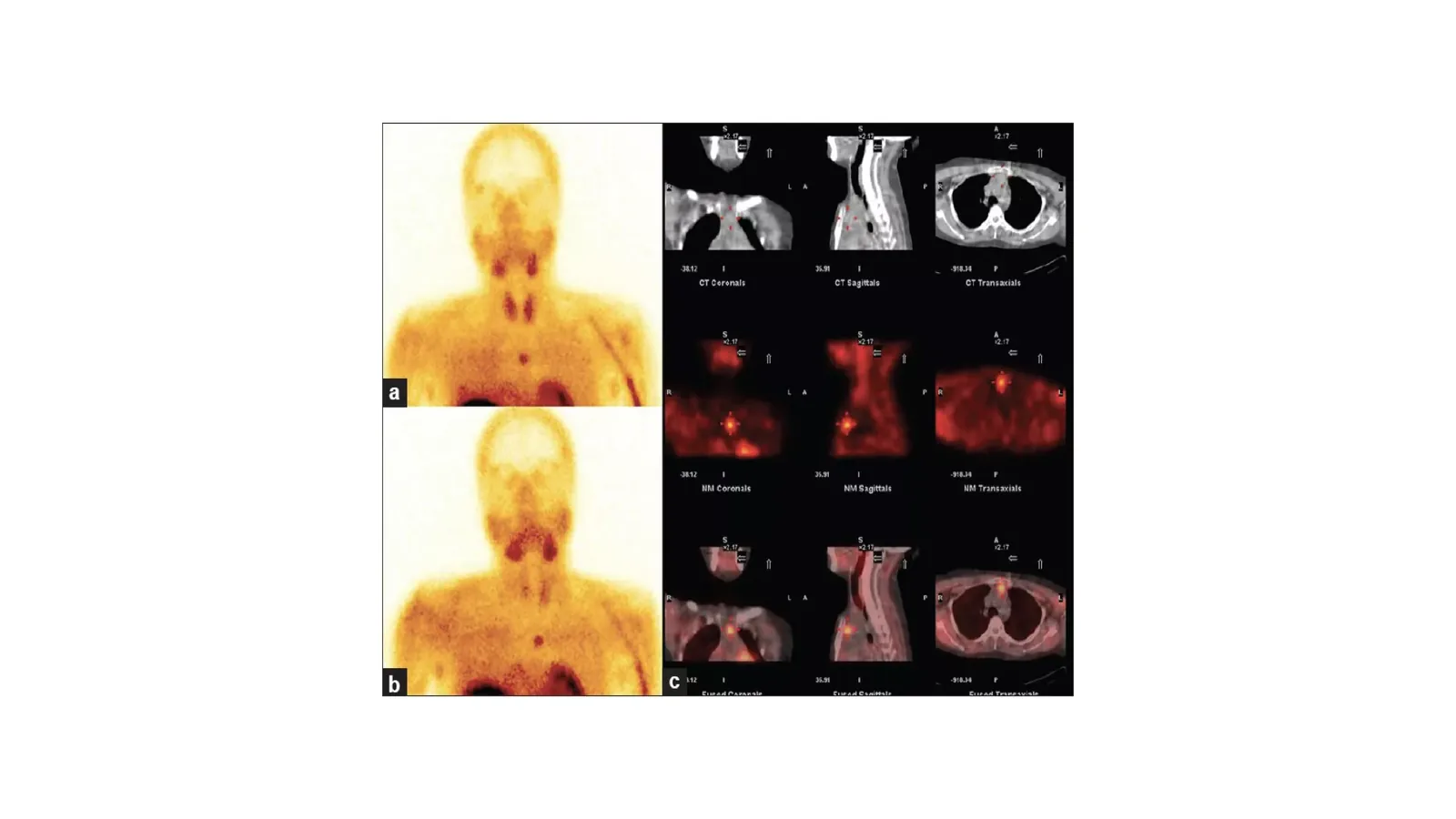 Medical scan images of the neck and chest used to locate a parathyroid gland