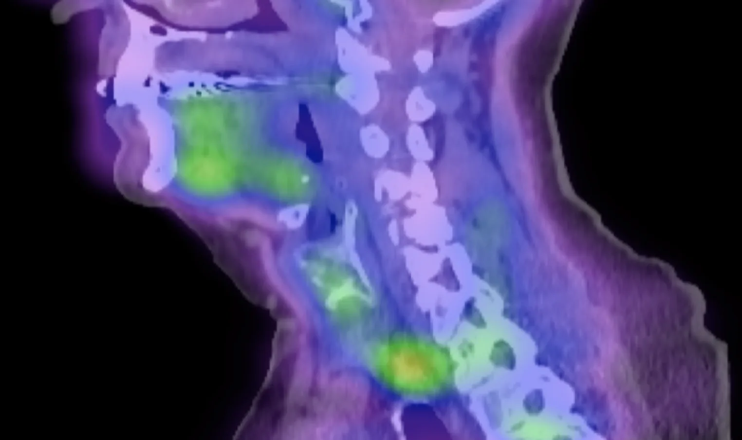 Side view of a combined PET-CT scan of the neck, with bright areas showing gland activity