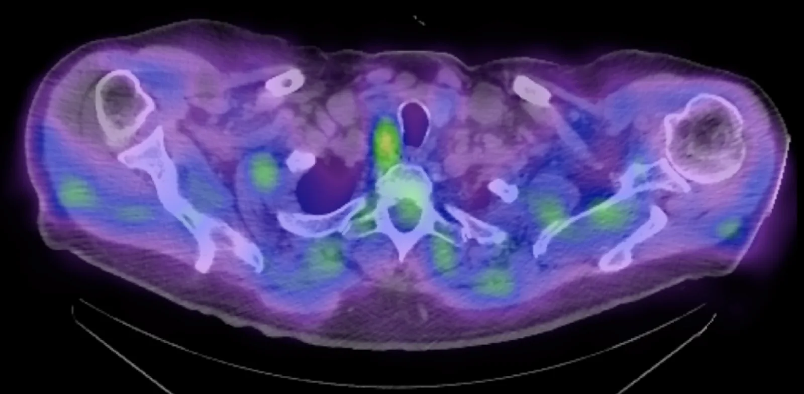 Cross-section of a combined PET-CT scan of the neck and shoulders