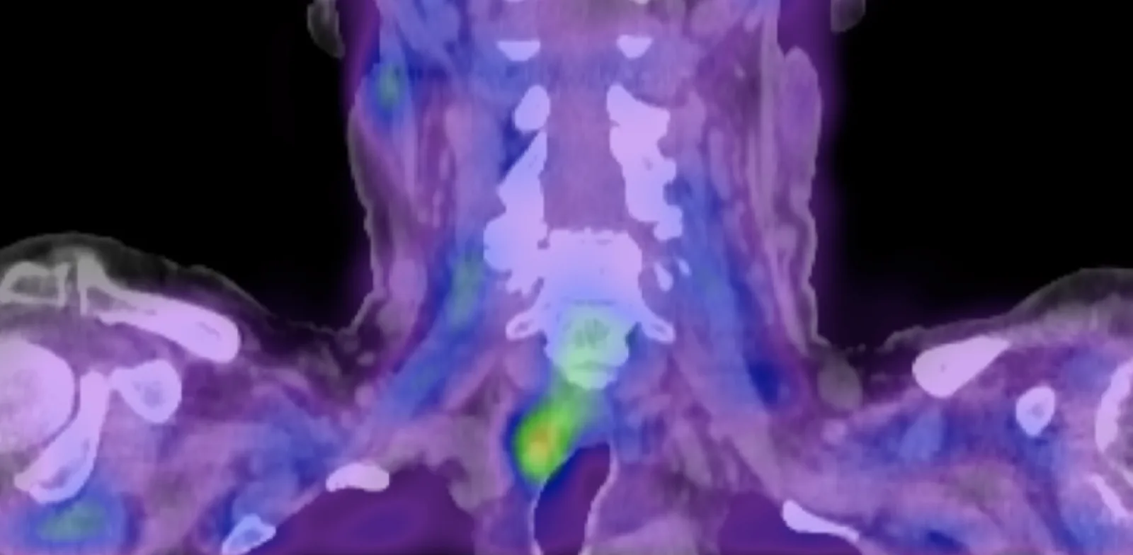 Front view of a combined PET-CT scan of the neck, with a bright spot low in the neck