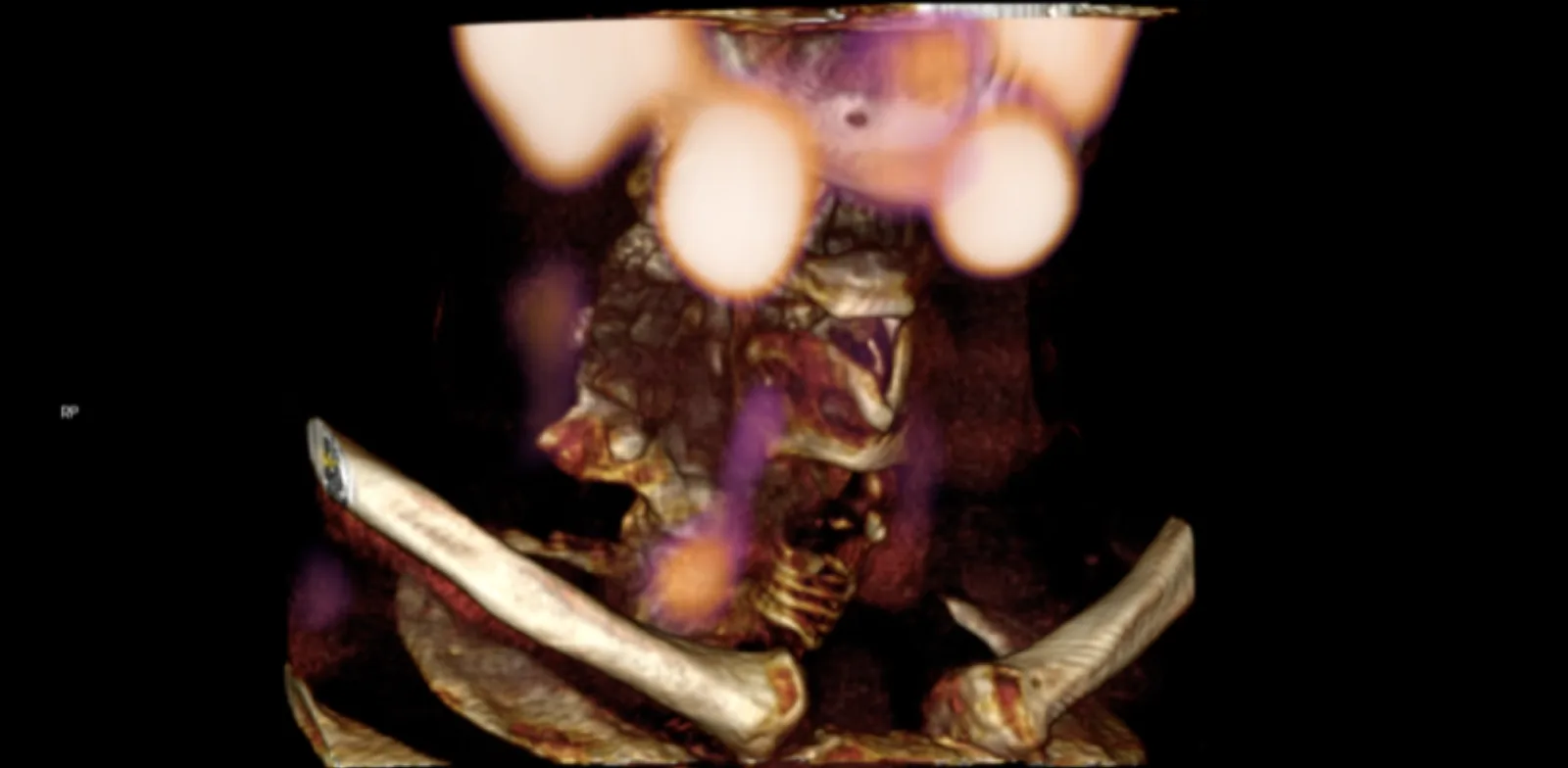 Three-dimensional CT image of the neck and collarbones