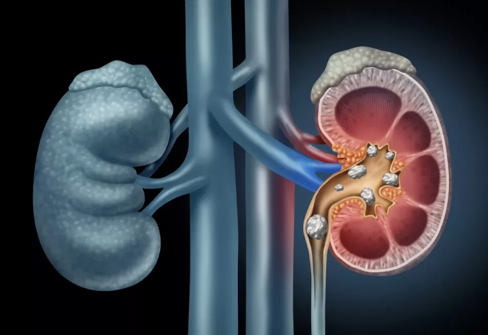 Illustration of a kidney cut open to show kidney stones