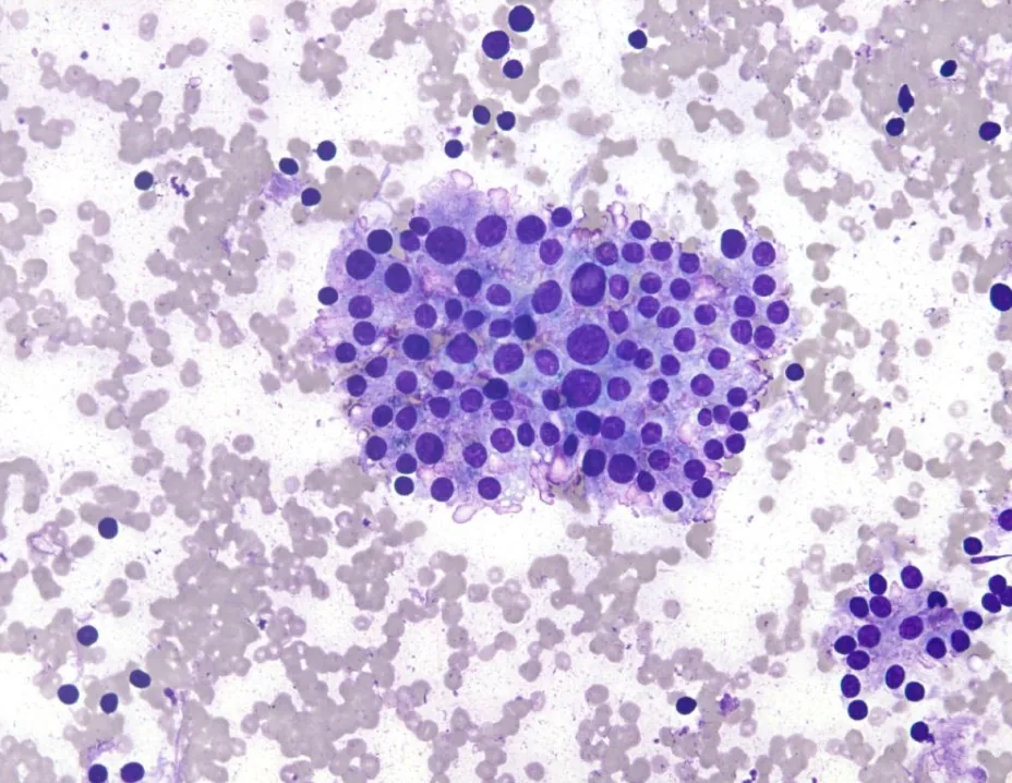 Microscope image of a cluster of thyroid cells from a needle sample