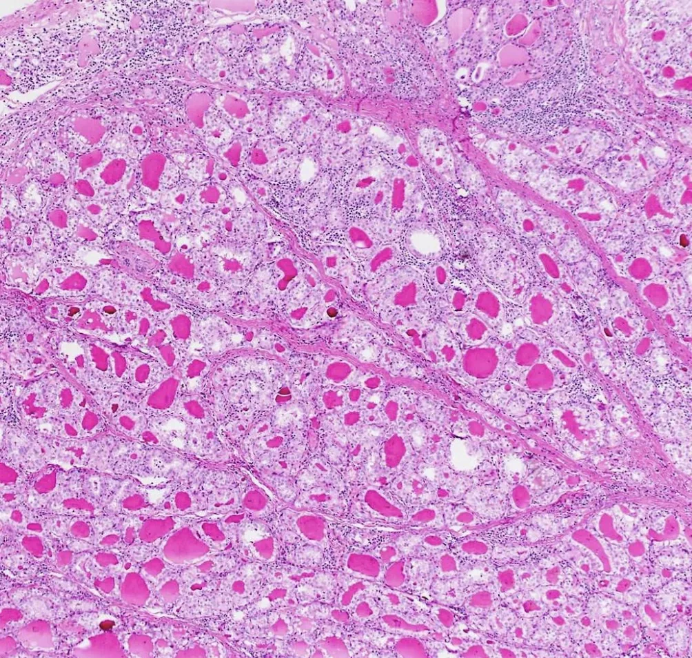 Low-magnification microscope image of thyroid tissue
