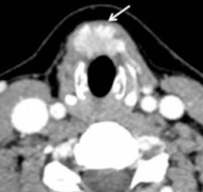 CT scan cross-section of the neck, with an arrow pointing to the thyroid gland