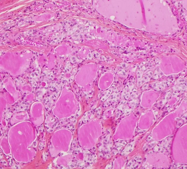 Microscope image of thyroid follicles in stained tissue