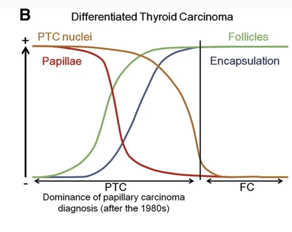 Diagram: features used to diagnose differentiated thyroid carcinoma, showing how papillae, PTC nuclei, follicles and encapsulation separate papillary carcinoma from follicular carcinoma