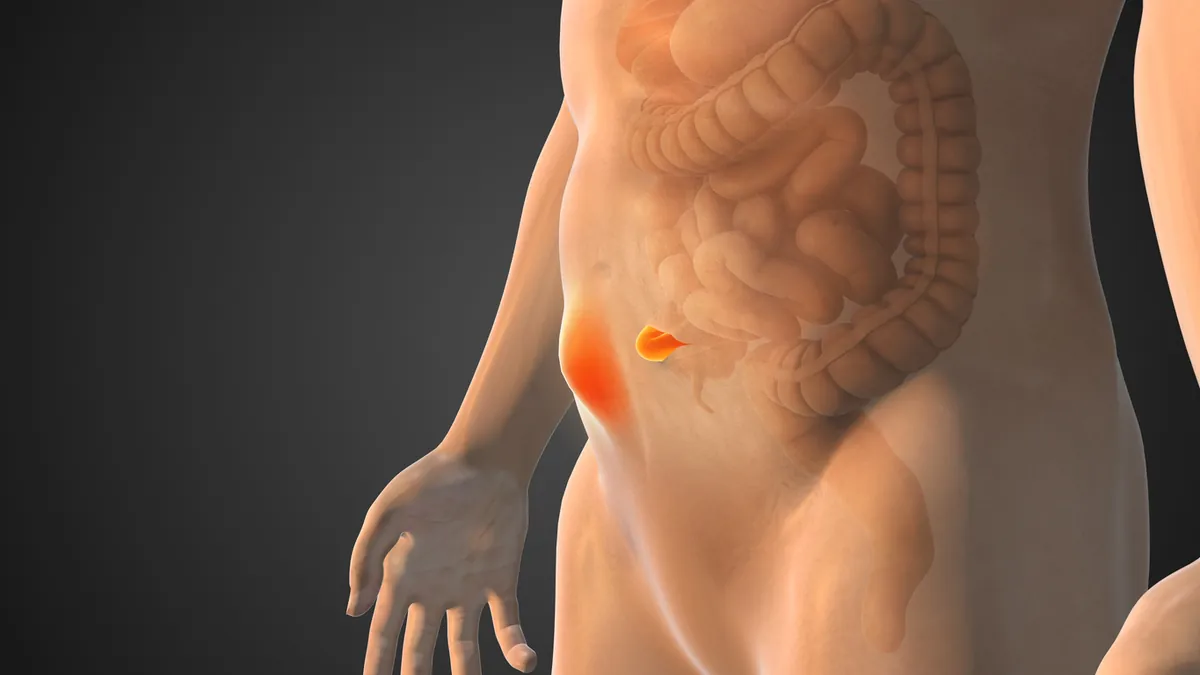 3D illustration of the lower abdomen with the appendix highlighted in orange on the right side