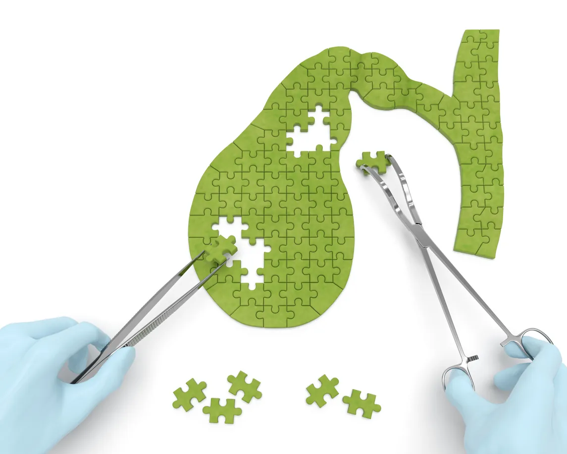 Concept image of a jigsaw-puzzle gallbladder with gloved hands holding surgical instruments
