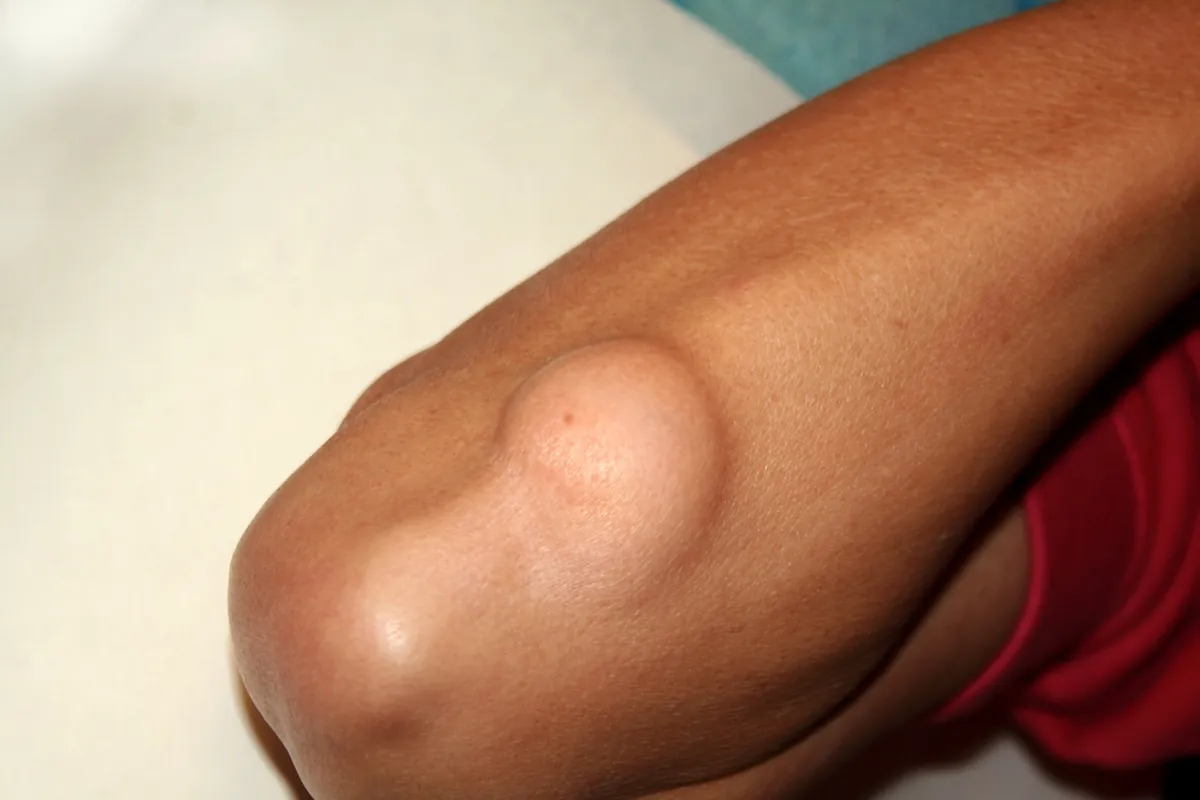 A smooth, rounded lump under the skin of a person's arm