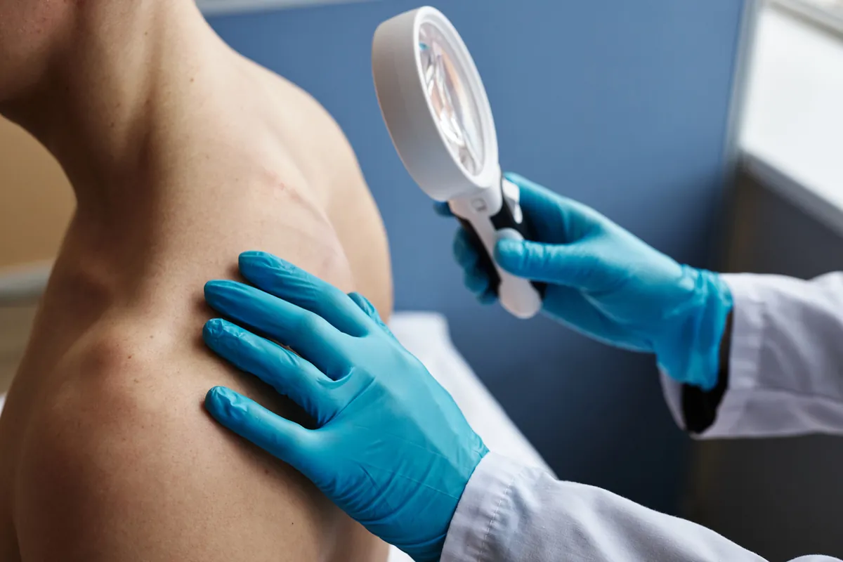 A doctor in blue gloves checking the skin of a patient's shoulder with a magnifying glass